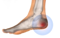 Diagnosis of Conditions Causing Heel Pain