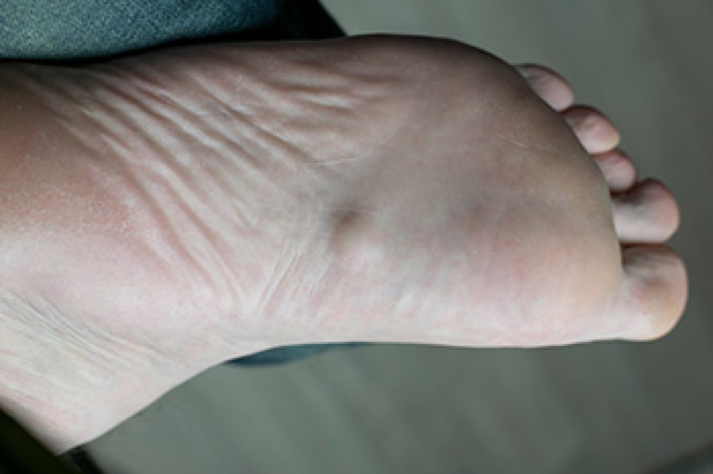 Risk Factors for Plantar Fibroma