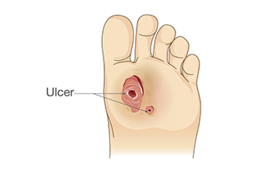 Getting Help for Diabetic Foot Ulcers