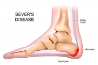 Sever’s Disease and the Heel’s Growth Plate