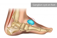 What Is a Ganglion Cyst?