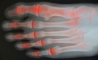 Many Different Types of Arthritis
