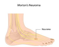 Morton’s Neuroma Causes Burning Pain