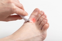 Signs of Athlete's Foot