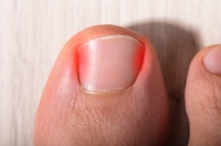 Causes of Ingrown Toenails