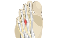 Treatment of Morton’s Neuroma