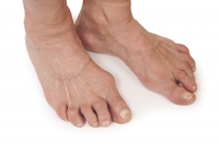 Rheumatoid Arthritis in Feet and Ankles